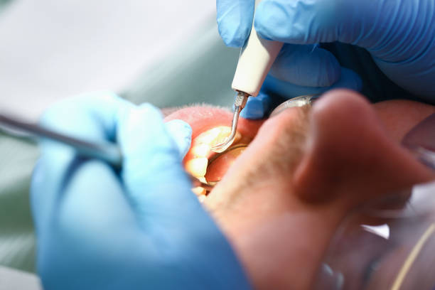 Best Emergency Treatment for Dental Infections or Abscesses in Hannahs Mill, GA