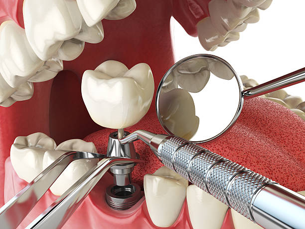 Best Emergency Dental Care for Broken or Chipped Teeth in Hannahs Mill, GA